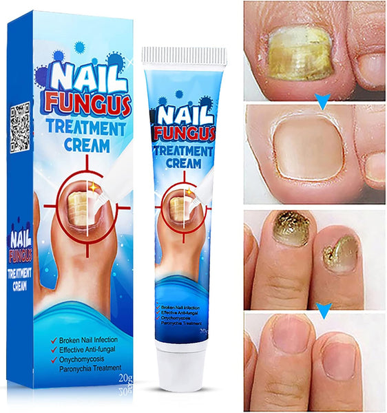 Fungus™ Crema para hongos uñas